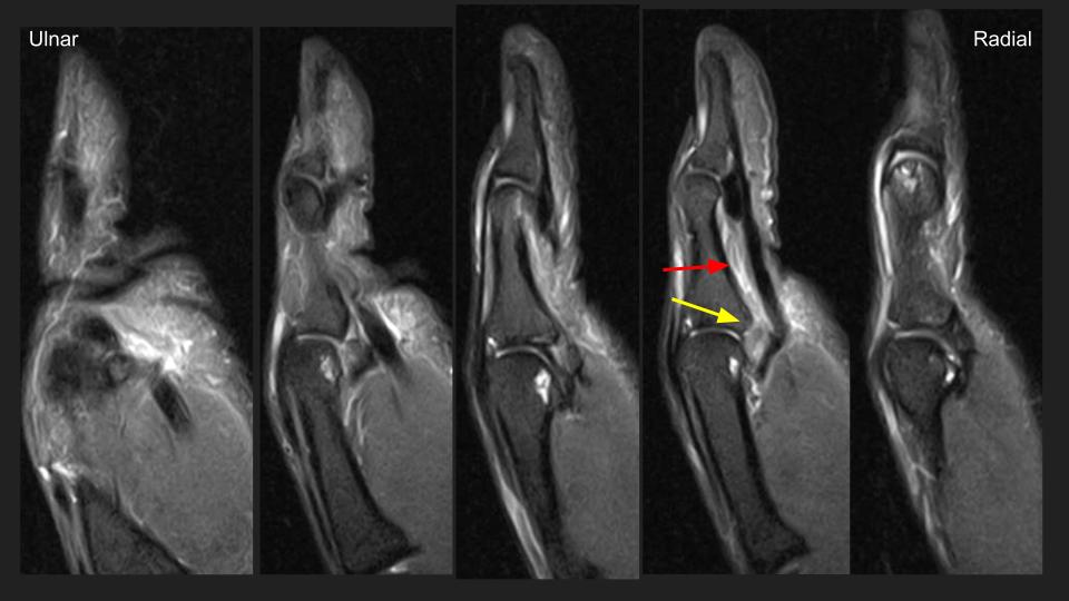 Figure 1 for case annular pulley of finger ( RID2435 )